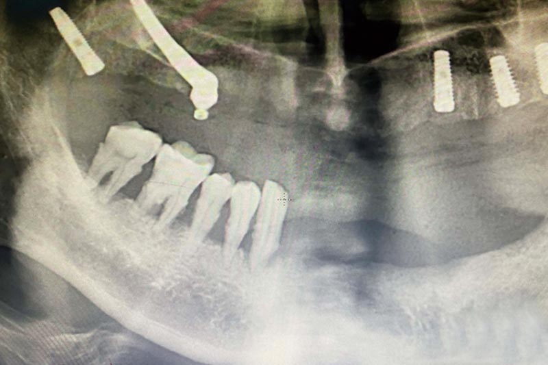 诺雅口腔医院孔院长为上颌牙槽骨严重不足患者行穿颧穿翼植体植入手术